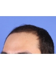 Before Hair Transplant&nbsp;Front